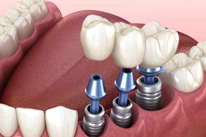 Transform Your Smile with Dental Implants in Mississauga: The Ultimate Guide to Tooth Replacement