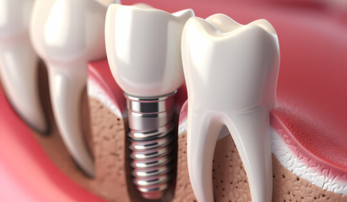 Are Dental Implants Worth It? A Comprehensive Guide to Their Value and Benefits